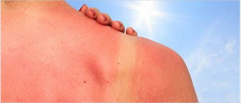 Sunburn easier when pregnant